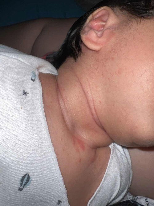 bintik merah pada wajah dan leher