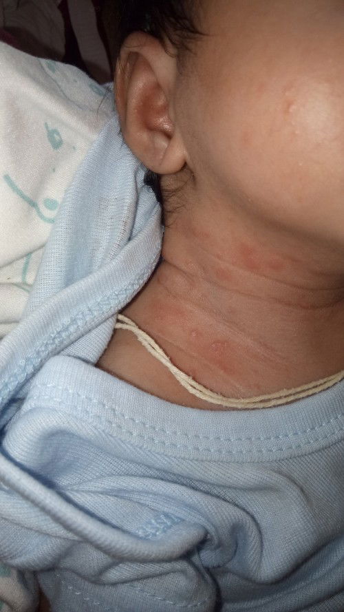 Gatal gatal merah pada leher