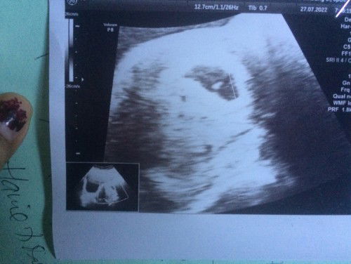 Hamil 12 week di USG bersih alias gk hamil