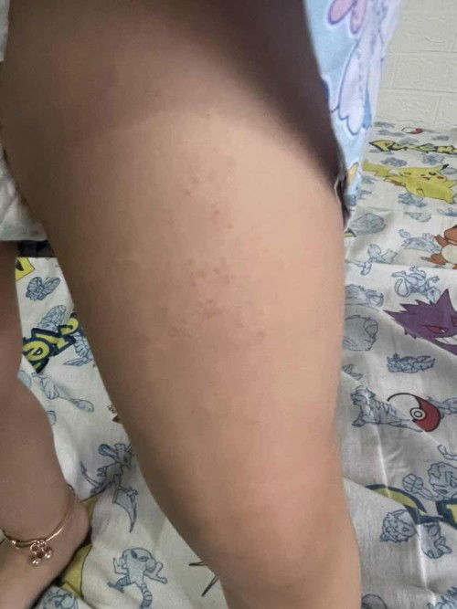 Bentol pada badan bayi