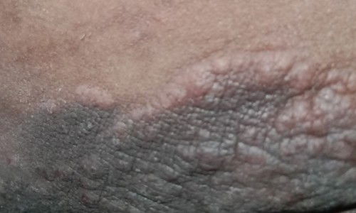 gatal di selangkangan setelah melahirkan