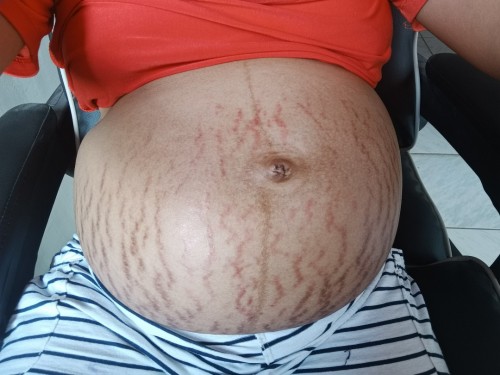 STRETCHMARK PROBLEM