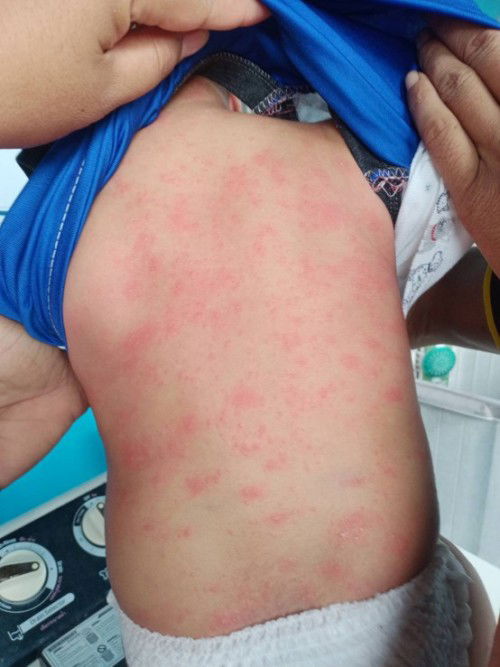 สอบถามเป็นผื่นแบบนี้เกิดจากน้องแพ้หรือเป็นผื่นอะไรคะ