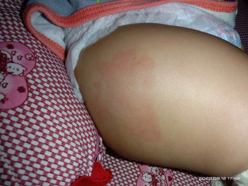 Dpt 3 tidak demam tapi bengkak dipaha kanan