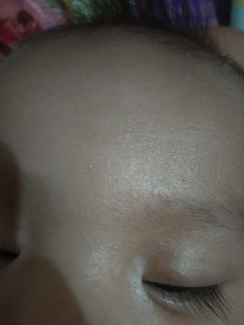 Bund, mau tanyak apa bunda pernh ngalamin gini. Anak bunda punya bercak putih dujung mata dkt hdung