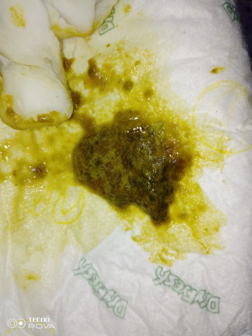 Hello mga momies After mag dede ni baby ko Tumatae kaagad siya minsan basa pupu niya minsan pa