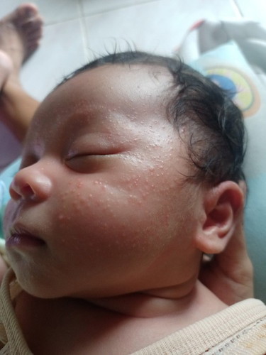 ลูกเป็นสิว