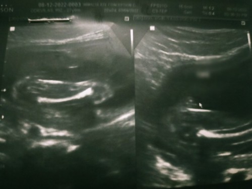 Ultrasound 21 weeks pregnant.