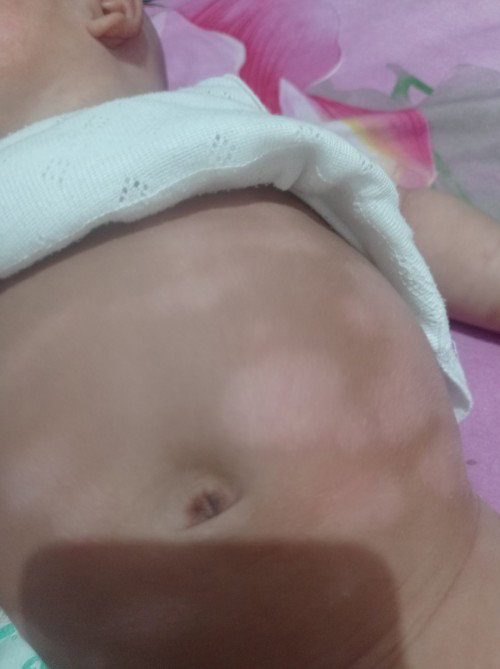 Bercak putih diperut bayi 3bln
