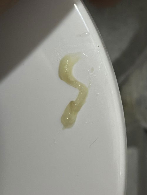 มูกออกมีสีน้ำตาลปนมาด้วย 38+4