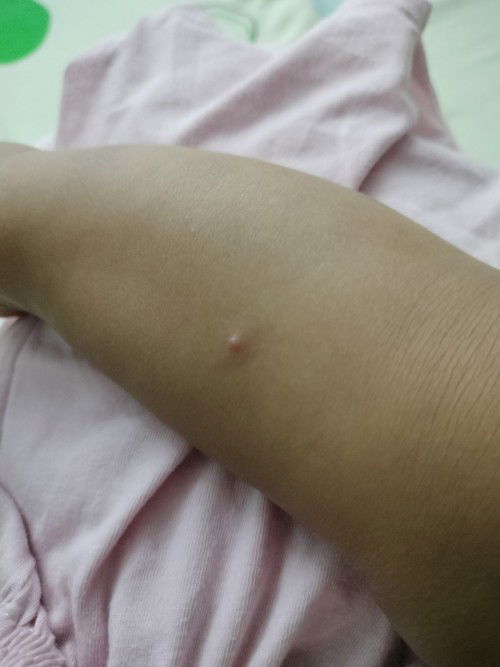 Nyamuk gigit dan parut