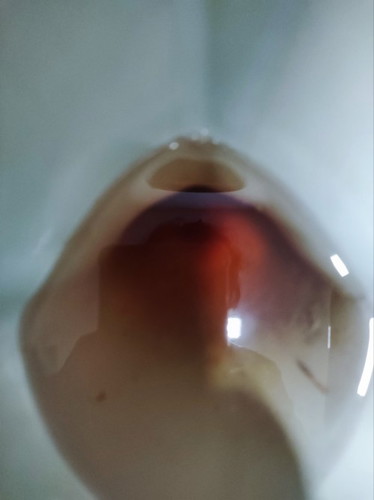 Bleeding 15weeks