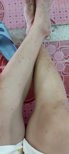 สอบถามแม่ๆหน่อยค่ะ ตอนนี้ 26 สัปดาห์แล้วแพ้ผื่นคันขึ้นทั้งตัวเลย ใครเป็นมันเราบ้างคะ