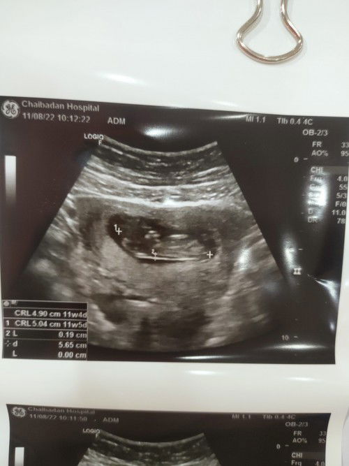 11 สัปดาห์ ขนาดประมาณนี้ไหมค่ะ