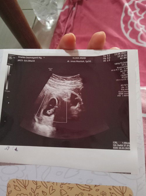 Masyallah hpht 16juni, di aplikasi 8w2d pas usg usia 8w . Semoga bunda dan janin sehat selalu 🥰🥰🥰