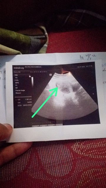 USG pertama kehamilan 4week 6 day ke 2 5week 2 day