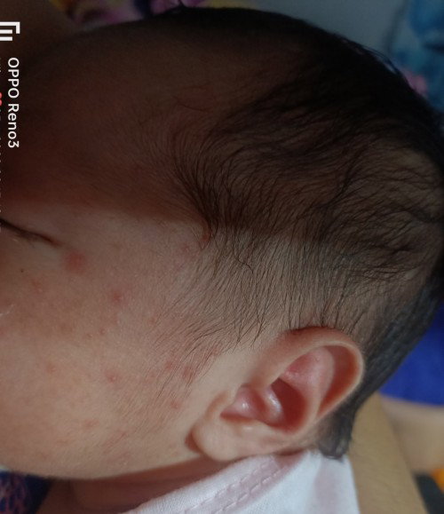 Rashes ni baby