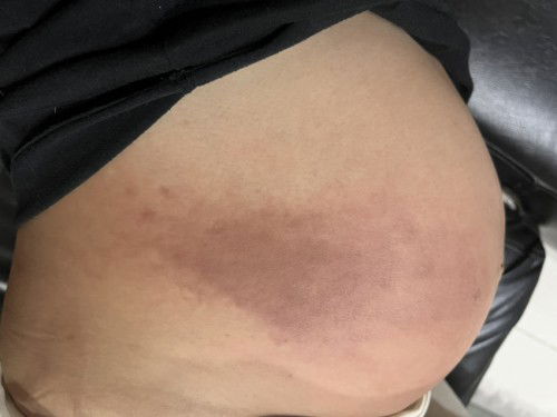 รอยดำที่ท้องเพราะเกาจะหายมั้ย