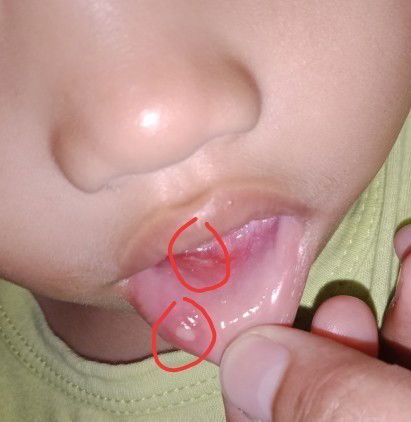 Obat sariawan anak 1 tahun