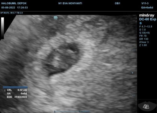 7W, pada saat usg 6W sudah ada CRL