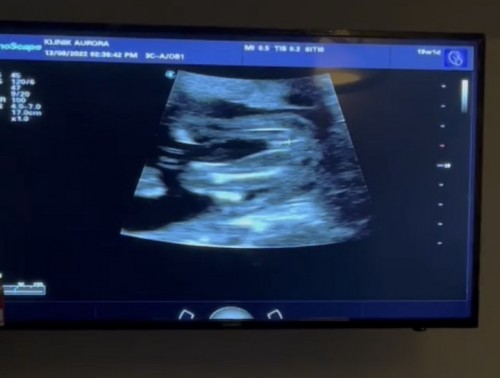 19 weeks growth scan