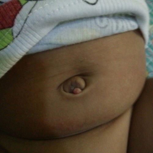 Muncul benjolan di pusar bayi