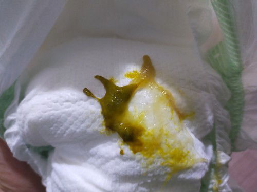 hello po mga mi tanong ko lang sino may same case na ganyan poop ni baby .. 5 months na po si lo