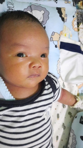 Mata Bayi Usia 3 Minggu tapi masih blm putih bersih. Badan jg masih kuning. Cara mengatasinya?
