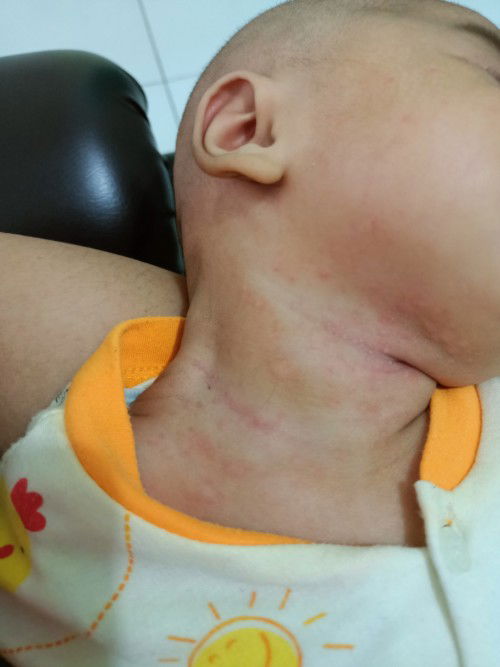 bintik-bintik merah dileher bayi 3 bulan , ini knpa ya bundaa? kasian lihatnya