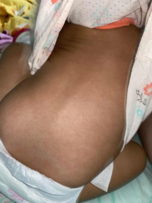 ผื่นแบบนี้คือผื่นอะไรหรอคะ หรือน้องเป็นผดคะ😅