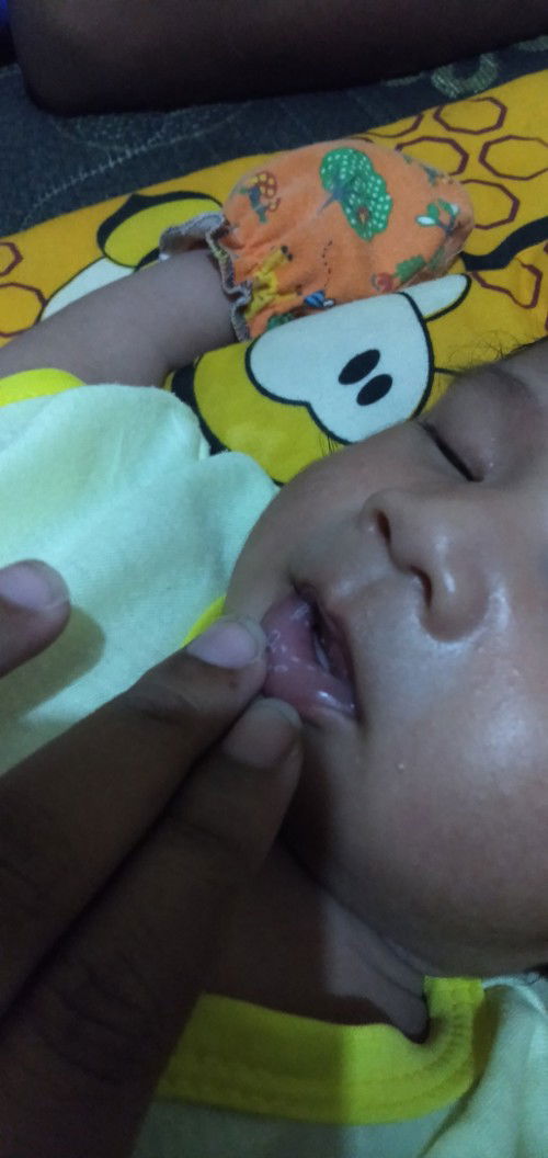 Kaya sariawan di bibir bayiku umur 19hari