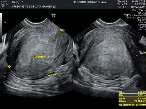 Usg baru penebalan dinding rahim