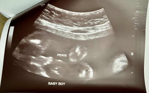 Congenital Anomaly Scan