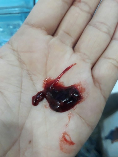 2 misccariage in 2 months. Ang sakit!!!!!