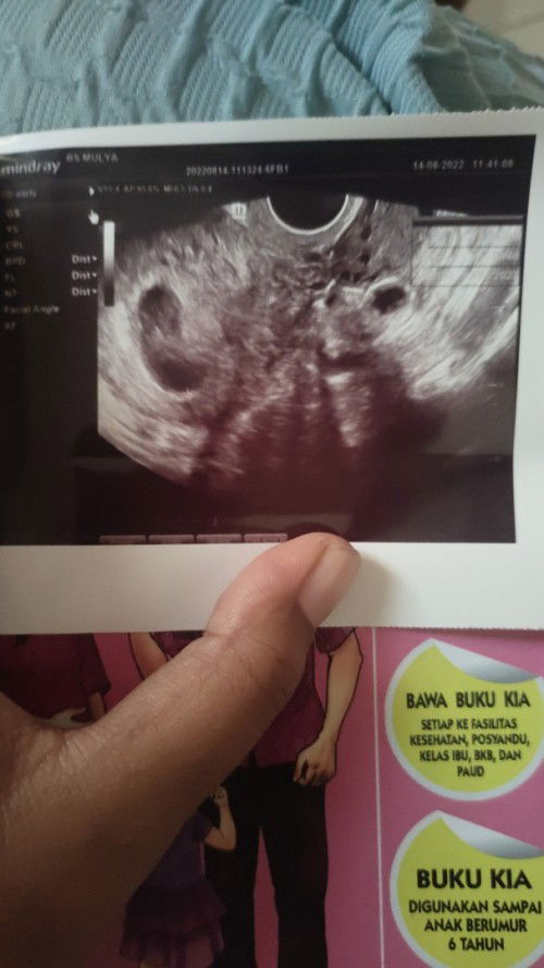 BELUM KELIHATAN JANINNYA HANYA KANTUNG NYA AJA 😢