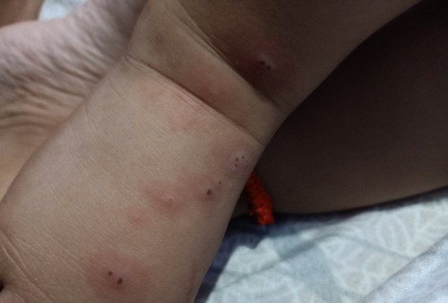 Hi po mga mommy ask ko lang po baka alam nyo kung anong kumagat sa paa ni lo ko.. Thank you
