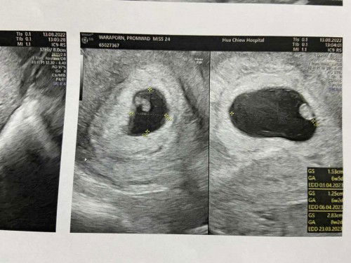 เมื่อวันที่13อัลตราซาวด์เจอตัวอ่อน ถุงไข่แดง แต่ไม่เห็นหัวใจน้องแบบนี้จะอันตรายไหมคะ