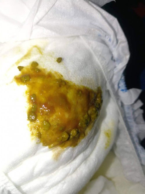 Kada dede poop si baby normal lang ba sa mga infant?