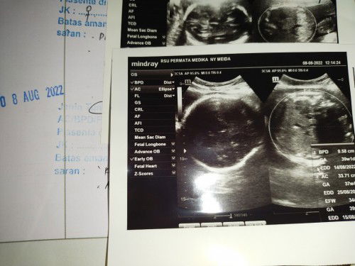 Usg kandungan 39w1d kepala janin sudah dibawah tp miring ke kanan