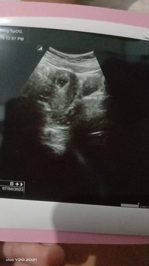 Seputar kehamilan 6week