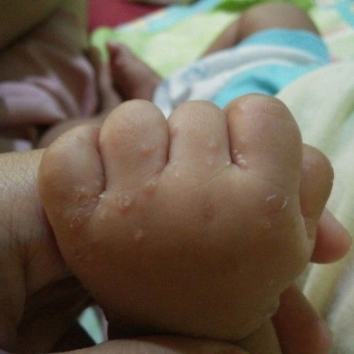 Muncul bintik2 di tangan dan kaki
