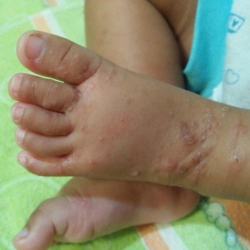 Bintik2 di kaki dan tangan