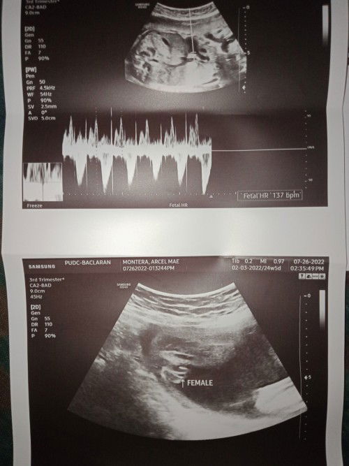 Good day mga mie ask ko lang kung normal lang ba ung baby ko nagpa ultrasound kasi ako thank u❤