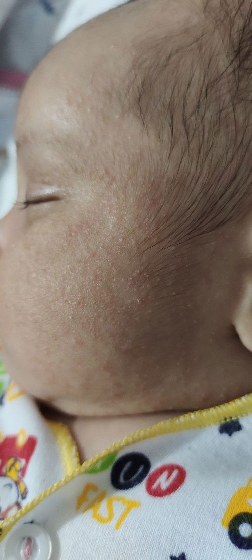 Ibu2 apakah ada yg punya bayi mukanya kayk begini kira2 pakai apa biar kembali mulus lagi?