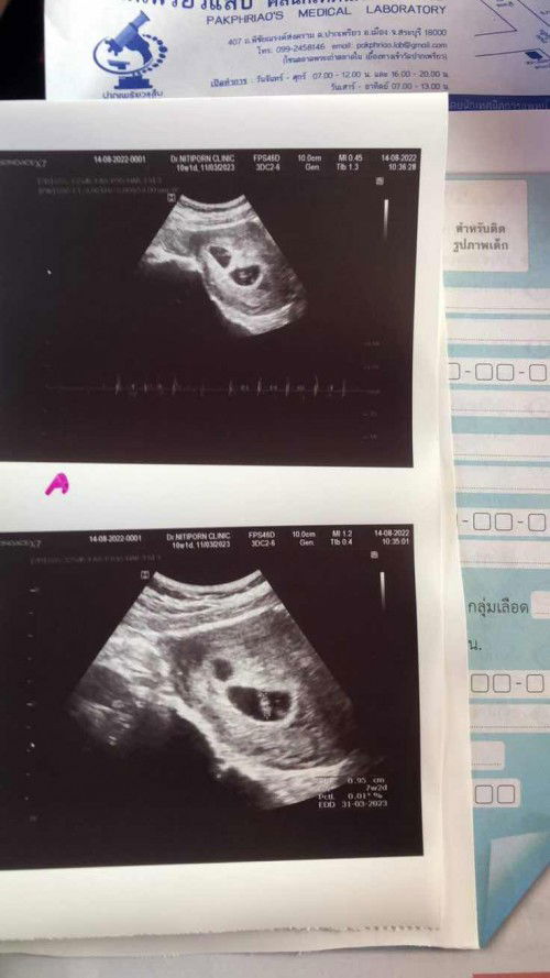 7week1day ซาวเจอ2ถุง หมอบอกว่าแฝด คนนึงเห็นหัวใจ แต่อีกคนไม่เห็น