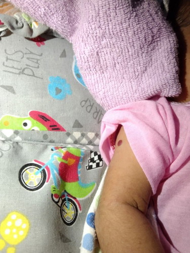 Assalamualaikum,mau bertanya, Apakah di lengan kanan anak saya itu bekas suntik atau tanda lahir ya?