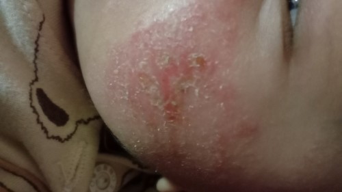 Ruam Susu pada muka bayi saya