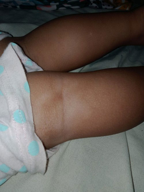 Puti puti sa balat ni Baby