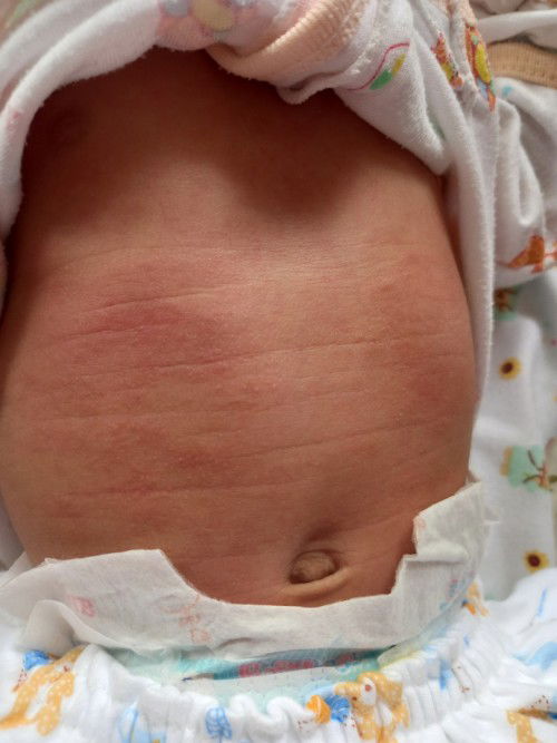 น้องมีผื่นแดงให้ตามตัว