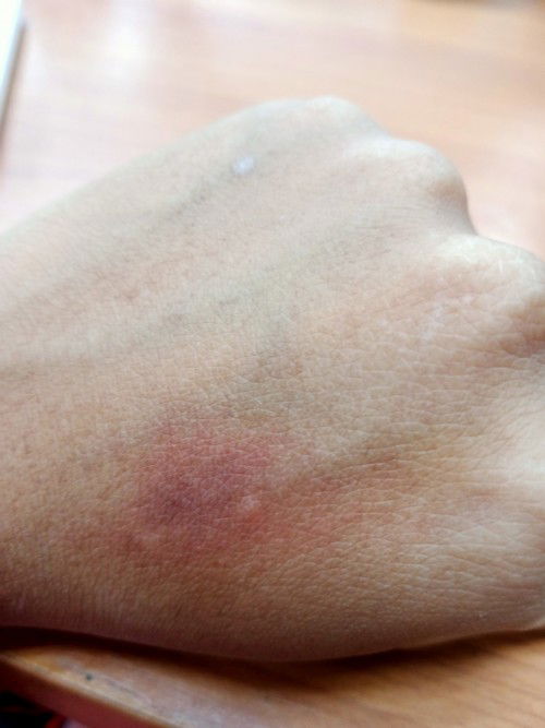 มีแม่บ้านใหนมีรอยช้ำแบบไม่รู้สาเหตุใหมค่ะ